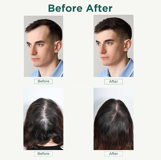 Thik&Fix Plus Natural Hair Nutrition Supplement for Men & Women with Saw Palmetto Oil, Vitamin B5 & E, Zinc, Biotin, Nourishes Scalp & Support Hair Growth for a Thicker, Fuller Look, 60 Softgels